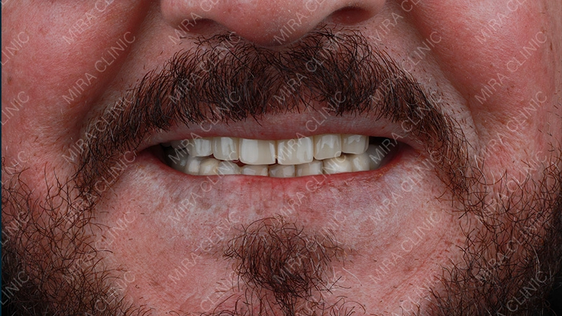Hollywood smile celebrity before after 